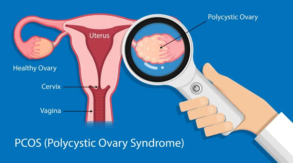PCOD detection in Uterus 